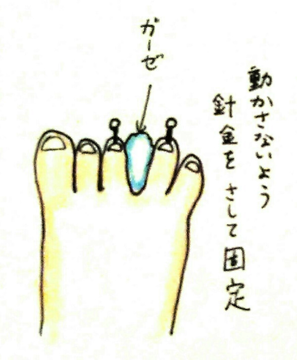 合趾症（合指症）の手術当日 | ぴょこりんの成長記録